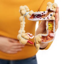 تشخیص التهاب روده (IBD)